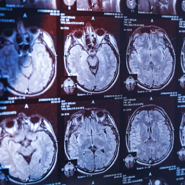 Alzheimer Alarmı! Erkeklerde Demans Riskini Katlayan Genetik Keşif