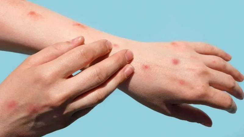 Okulda çiçek hastalığı alarmı! Bir sınıfta eğitime ara verildi