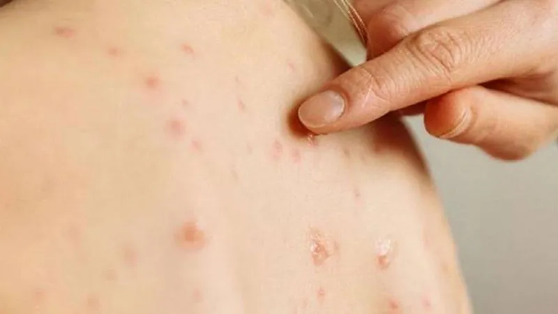 Son 25 yılın en yüksek seviyesine ulaştı! Dünya genelinde kızamık alarmı